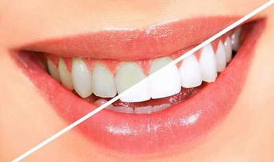 فلوئوروزیس دندانی(Dental Fluorosis)