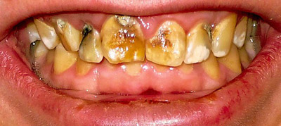 فلوئوروزیس دندانی(Dental Fluorosis)