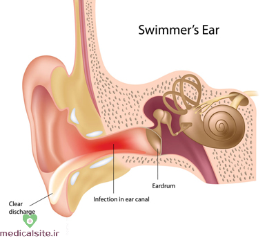 درمان التهاب گوش, التهاب گوش خارجی
